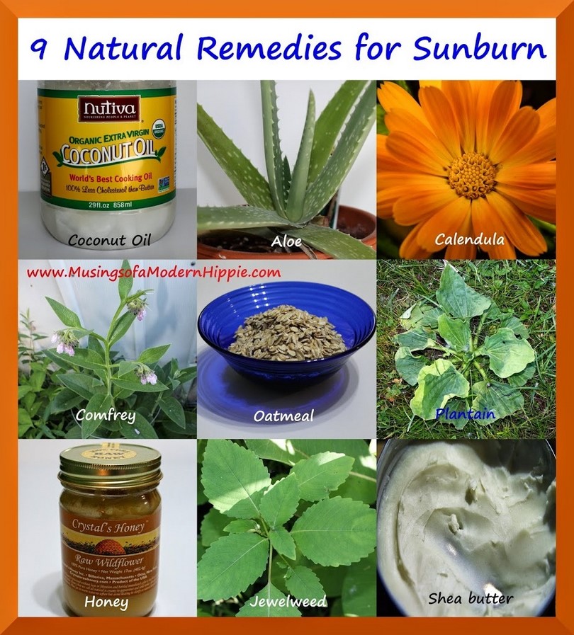 Home remedies for sunburns