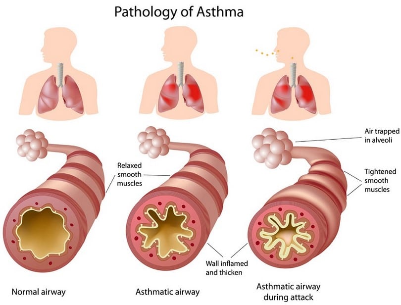 Pathology of asthma