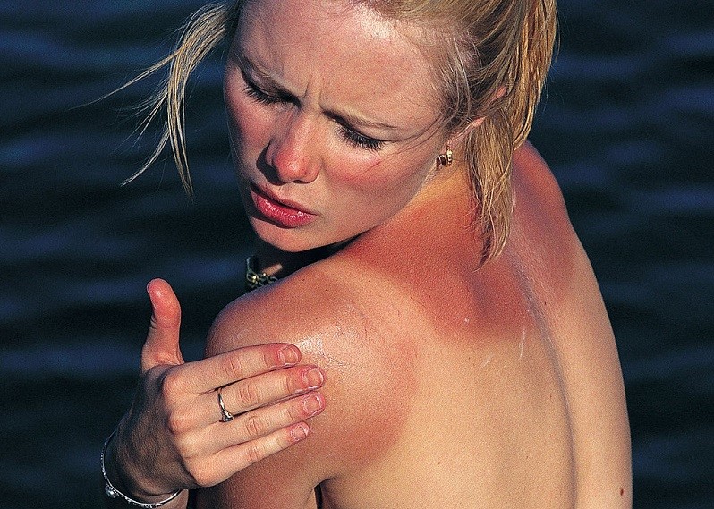 Woman with sunburn pain 