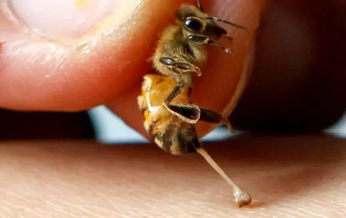 Removing Bee Stinger