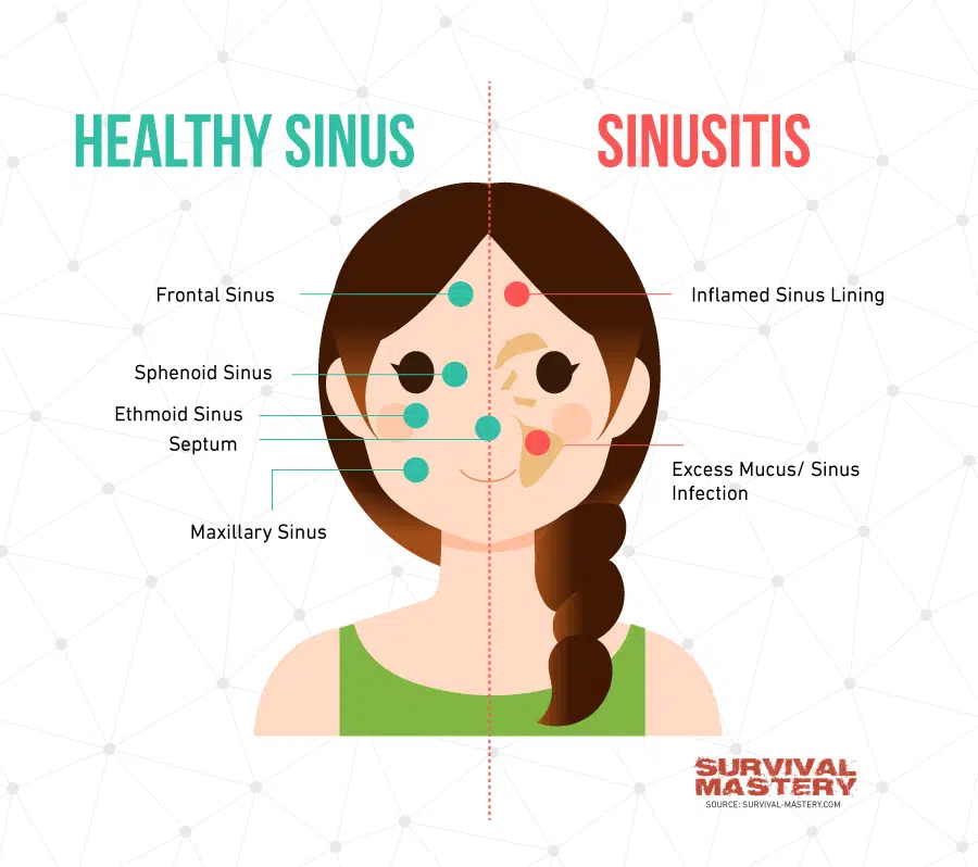 Sinus Infection Treatment infographic