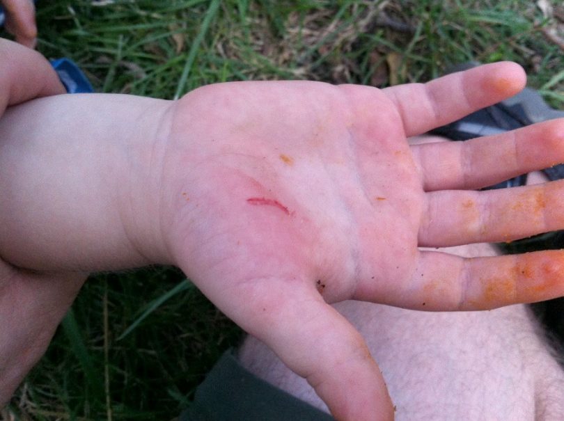 Camping cut on the hand