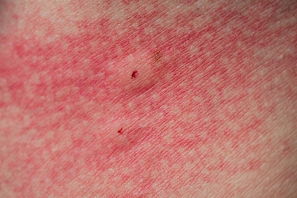 Red rash from angry spider bite